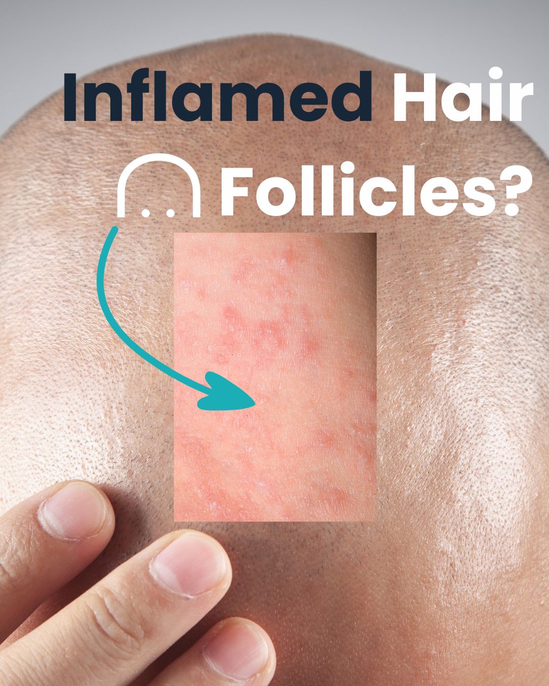 Inflamed Hair Follicles in Bald Men: 7 tips to prevent folliculitis on your bald head